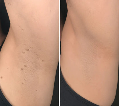 ✨Kevoria®2-in-1 Microneedle & Hydrocolloid Patch🍀