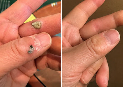 ✨Kevoria®2-in-1 Microneedle & Hydrocolloid Patch🍀